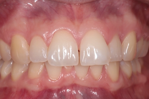 Zahnschienenbehandlung mit Aligner - Frontansicht vorher