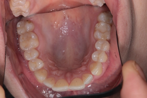 Zahnschienenbehandlung mit Aligner - Oberkiefer vorher