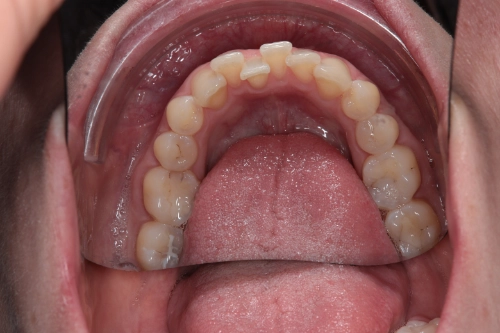 Zahnschienenbehandlung mit Aligner - Unterkiefer vorher