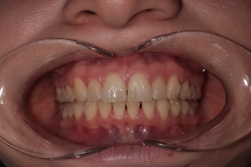 Zahnschienenbehandlung mit Aligner - Frontansicht Zwischenstand