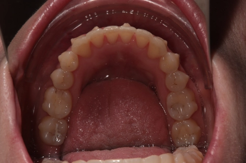 Zahnschienenbehandlung mit Aligner - Unterkiefer Zwischenstand